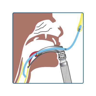 SunMed Sun-Med Endotracheal Tube Introducers (Bougie)